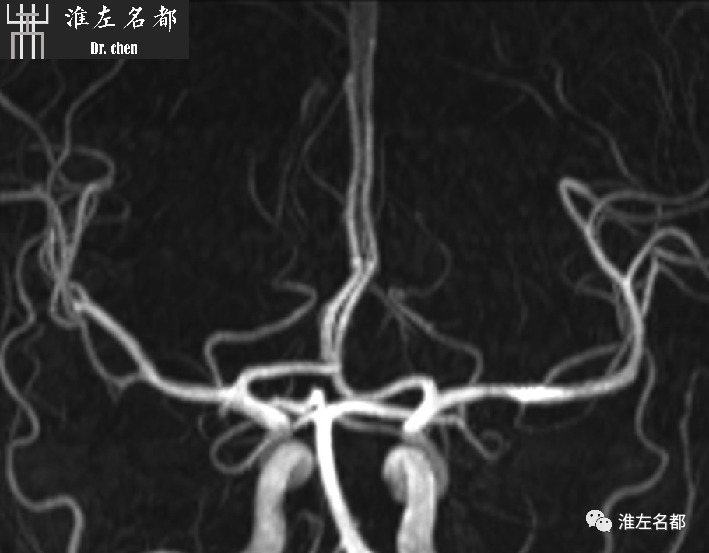 影像PPT - 图解脑桥梗死、豆纹动脉梗死机制 、解剖和示意图-91 影像PPT - 图解脑桥梗死、豆纹动脉梗死机制 、解剖和示意图-91