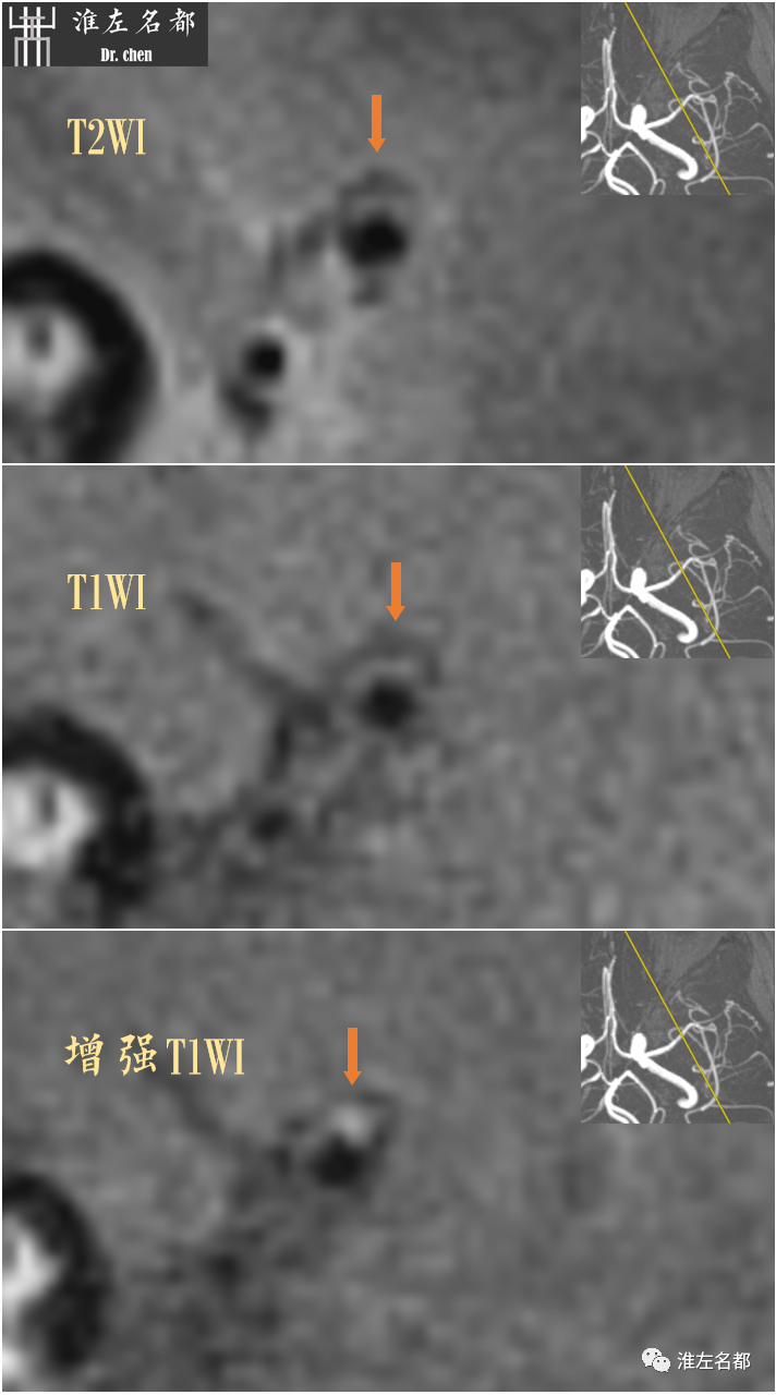 影像PPT - 图解脑桥梗死、豆纹动脉梗死机制 、解剖和示意图-90 影像PPT - 图解脑桥梗死、豆纹动脉梗死机制 、解剖和示意图-90
