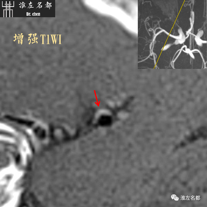 影像PPT - 图解脑桥梗死、豆纹动脉梗死机制 、解剖和示意图-96 影像PPT - 图解脑桥梗死、豆纹动脉梗死机制 、解剖和示意图-96