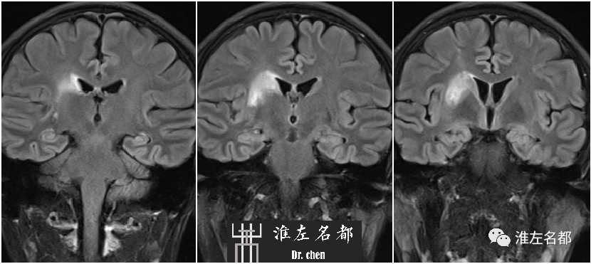 影像PPT - 图解脑桥梗死、豆纹动脉梗死机制 、解剖和示意图-101 影像PPT - 图解脑桥梗死、豆纹动脉梗死机制 、解剖和示意图-101
