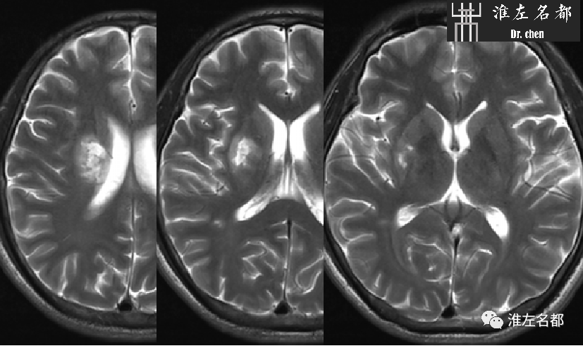 影像PPT - 图解脑桥梗死、豆纹动脉梗死机制 、解剖和示意图-100 影像PPT - 图解脑桥梗死、豆纹动脉梗死机制 、解剖和示意图-100