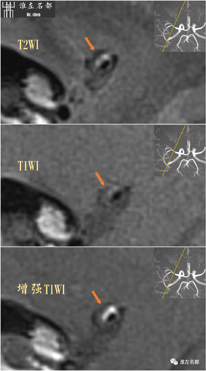 影像PPT - 图解脑桥梗死、豆纹动脉梗死机制 、解剖和示意图-102