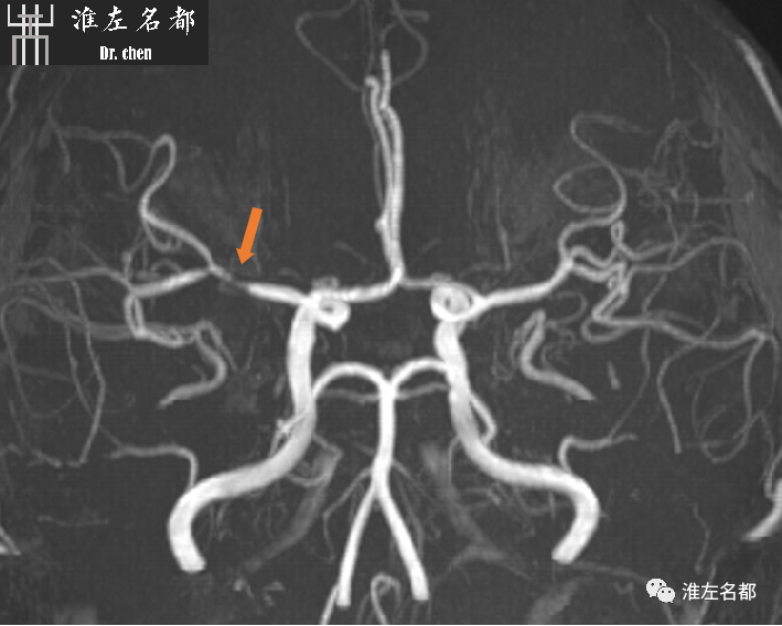 影像PPT - 图解脑桥梗死、豆纹动脉梗死机制 、解剖和示意图-99 影像PPT - 图解脑桥梗死、豆纹动脉梗死机制 、解剖和示意图-99