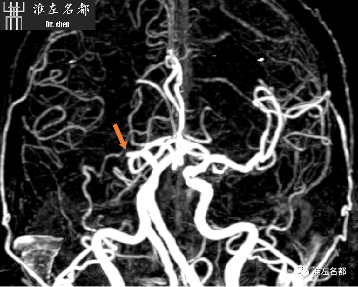 影像PPT - 图解脑桥梗死、豆纹动脉梗死机制 、解剖和示意图-108
