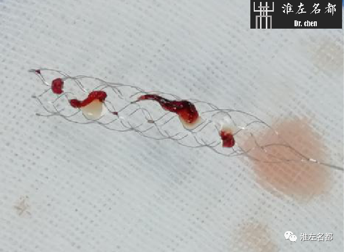 影像PPT - 图解脑桥梗死、豆纹动脉梗死机制 、解剖和示意图-110 影像PPT - 图解脑桥梗死、豆纹动脉梗死机制 、解剖和示意图-110