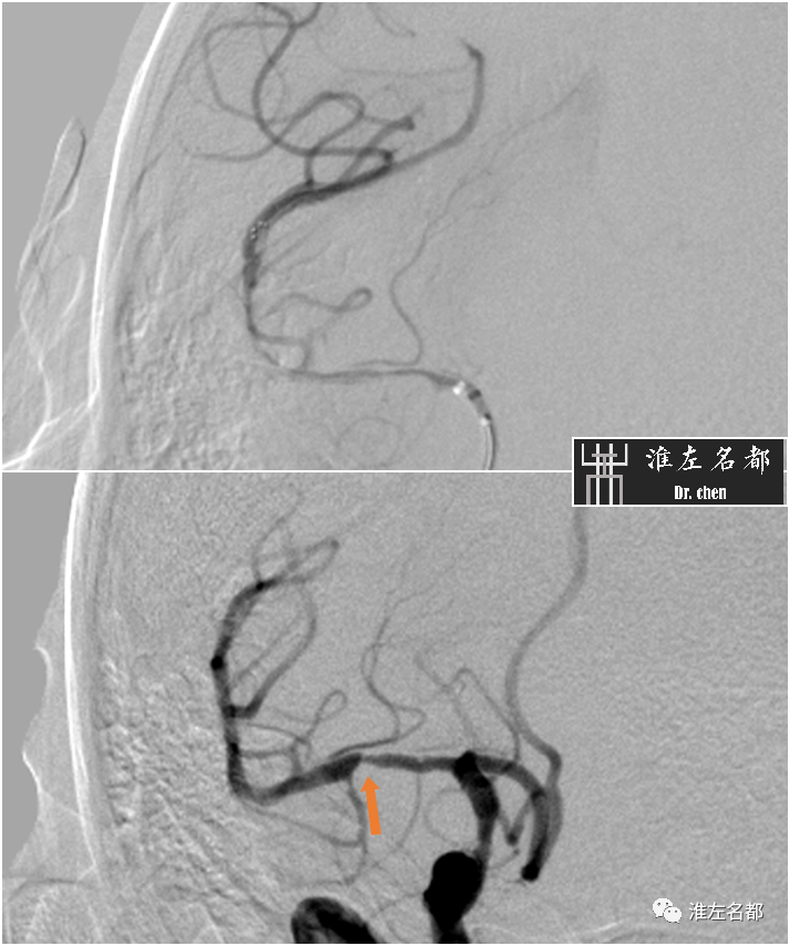 影像PPT - 图解脑桥梗死、豆纹动脉梗死机制 、解剖和示意图-109 影像PPT - 图解脑桥梗死、豆纹动脉梗死机制 、解剖和示意图-109