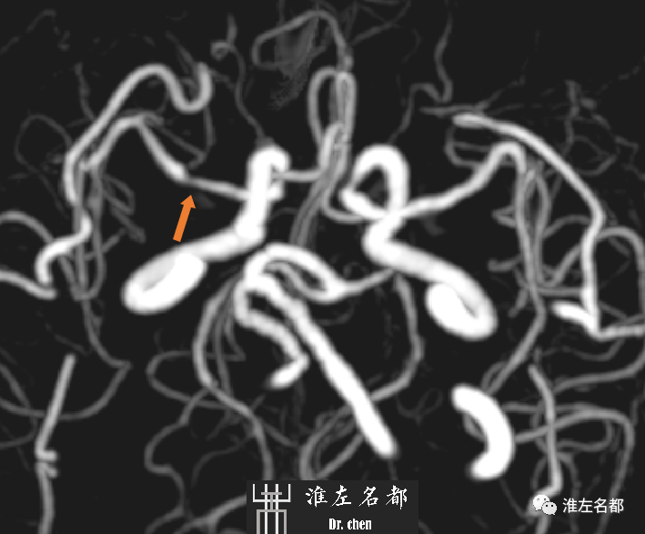 影像PPT - 图解脑桥梗死、豆纹动脉梗死机制 、解剖和示意图-111 影像PPT - 图解脑桥梗死、豆纹动脉梗死机制 、解剖和示意图-111