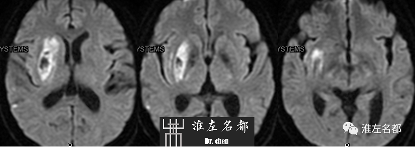 影像PPT - 图解脑桥梗死、豆纹动脉梗死机制 、解剖和示意图-112 影像PPT - 图解脑桥梗死、豆纹动脉梗死机制 、解剖和示意图-112
