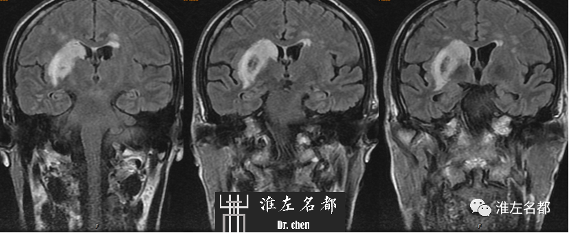 影像PPT - 图解脑桥梗死、豆纹动脉梗死机制 、解剖和示意图-113 影像PPT - 图解脑桥梗死、豆纹动脉梗死机制 、解剖和示意图-113