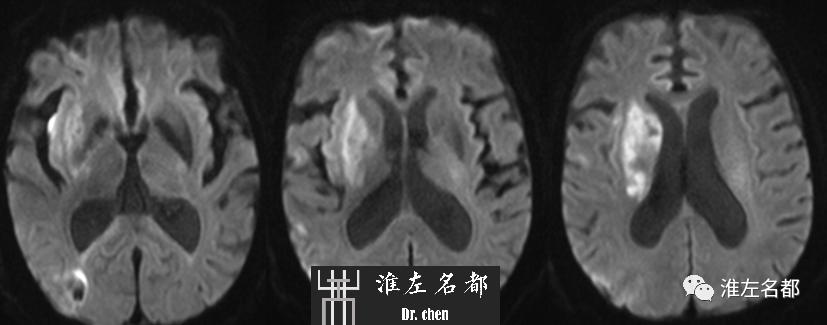 影像PPT - 图解脑桥梗死、豆纹动脉梗死机制 、解剖和示意图-120 影像PPT - 图解脑桥梗死、豆纹动脉梗死机制 、解剖和示意图-120