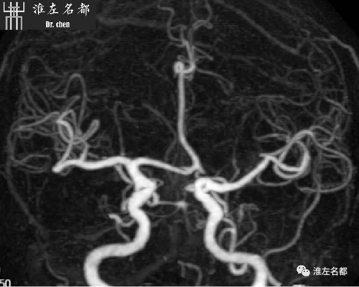 影像PPT - 图解脑桥梗死、豆纹动脉梗死机制 、解剖和示意图-119 影像PPT - 图解脑桥梗死、豆纹动脉梗死机制 、解剖和示意图-119