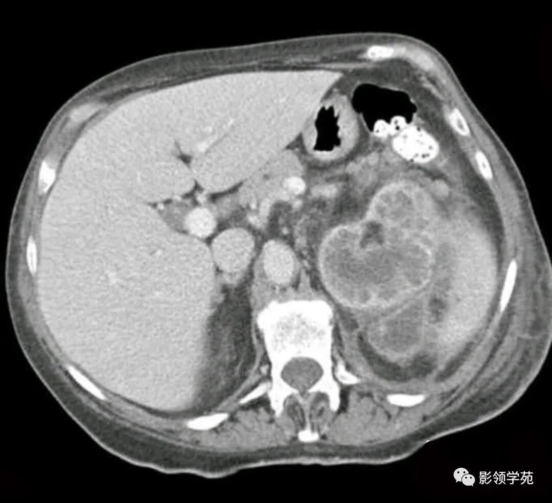 影像PPT - 【病例】黄色肉芽肿性肾盂肾炎1例CT-1