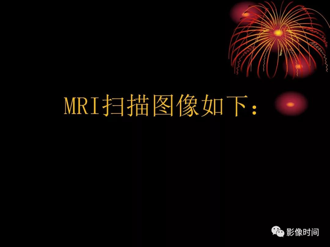 影像PPT - 【病例】鼻咽部淋巴瘤1例MR影像-3