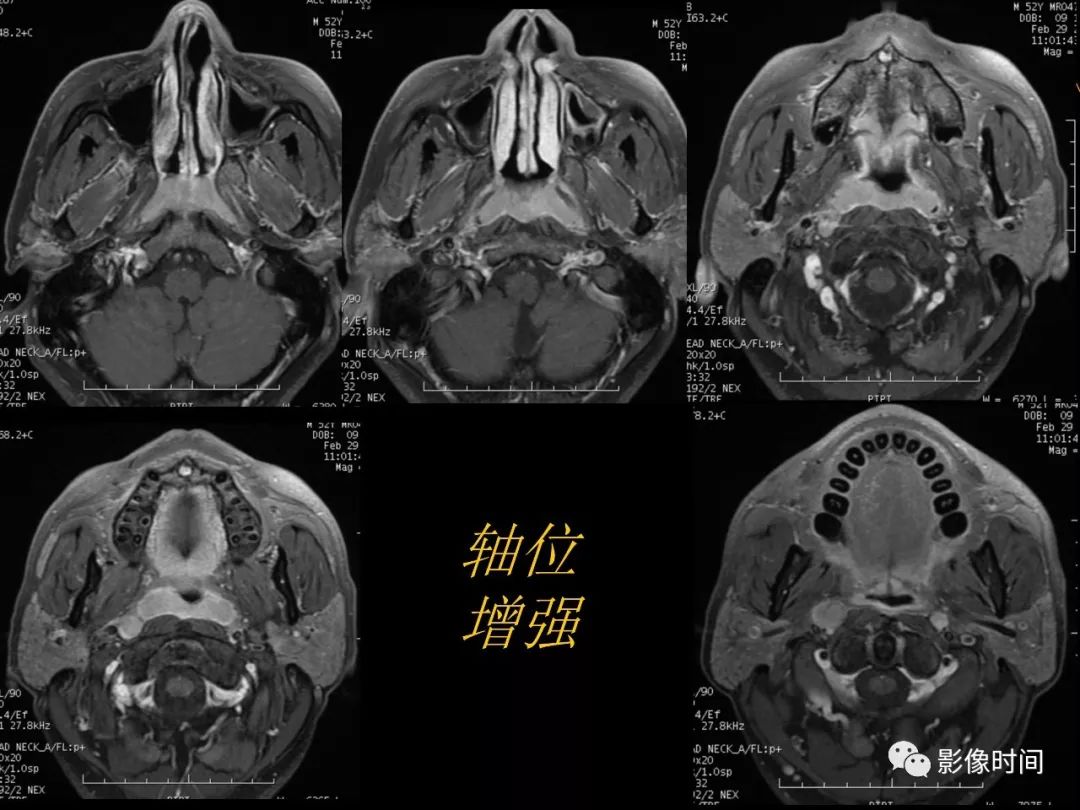 影像PPT - 【病例】鼻咽部淋巴瘤1例MR影像-10