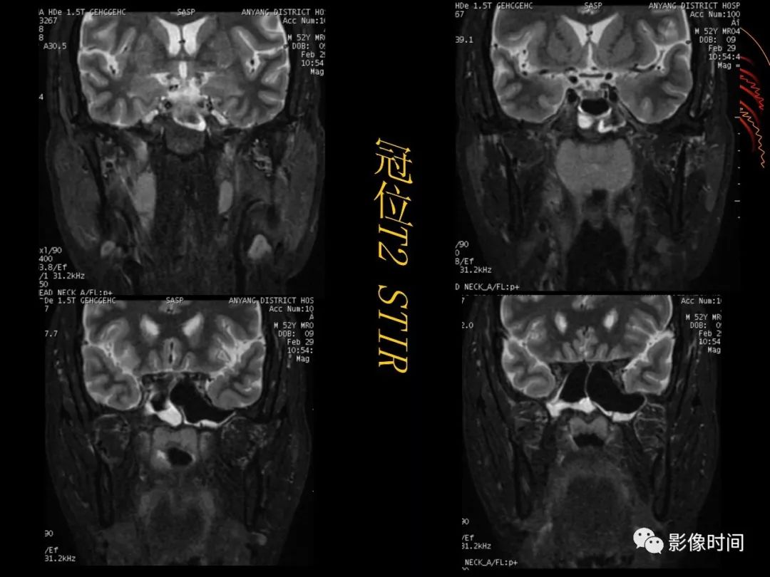 影像PPT - 【病例】鼻咽部淋巴瘤1例MR影像-8