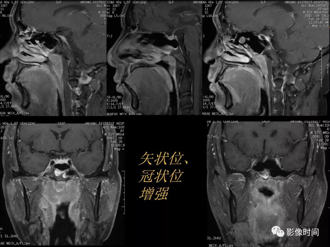 影像PPT - 【病例】鼻咽部淋巴瘤1例MR影像-11