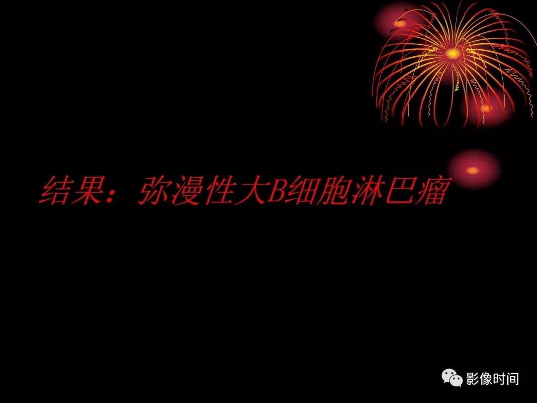 影像PPT - 【病例】鼻咽部淋巴瘤1例MR影像-13