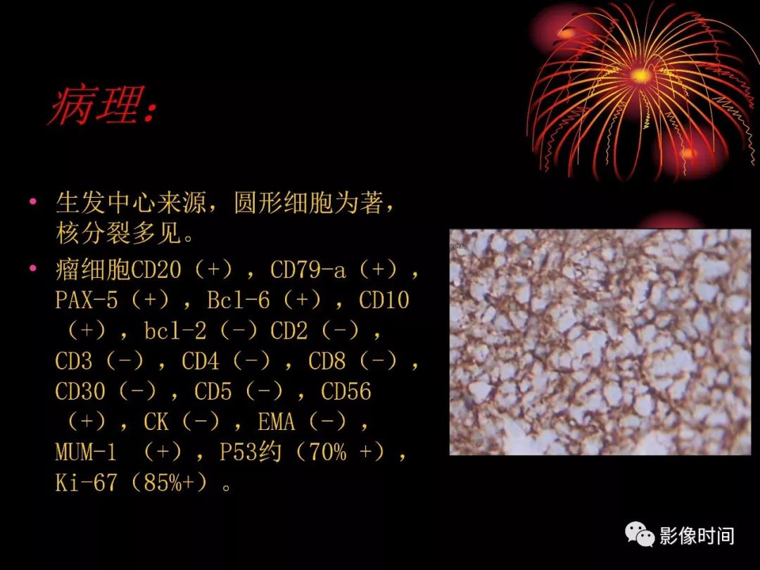 影像PPT - 【病例】鼻咽部淋巴瘤1例MR影像-14