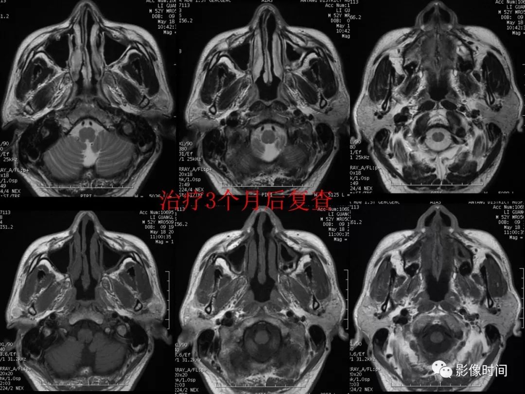 影像PPT - 【病例】鼻咽部淋巴瘤1例MR影像-15