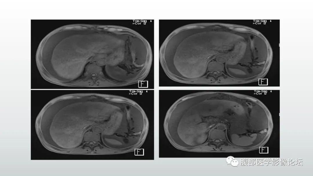 影像PPT - 【病例】肝窦阻塞综合征（肝小静脉闭塞病）CT及MR一例-7