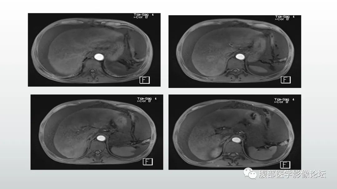 影像PPT - 【病例】肝窦阻塞综合征（肝小静脉闭塞病）CT及MR一例-8