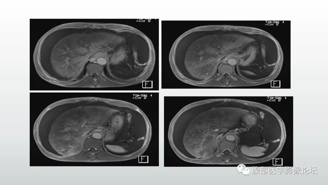 影像PPT - 【病例】肝窦阻塞综合征（肝小静脉闭塞病）CT及MR一例-10