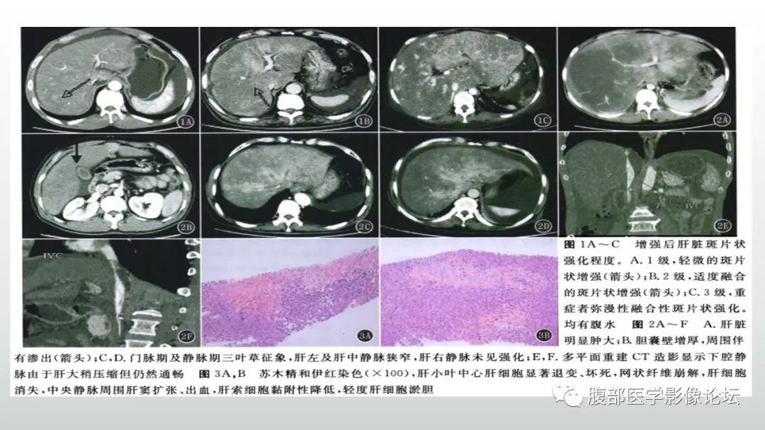 影像PPT - 【病例】肝窦阻塞综合征（肝小静脉闭塞病）CT及MR一例-23