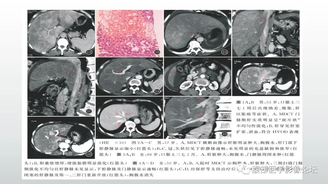 影像PPT - 【病例】肝窦阻塞综合征（肝小静脉闭塞病）CT及MR一例-24