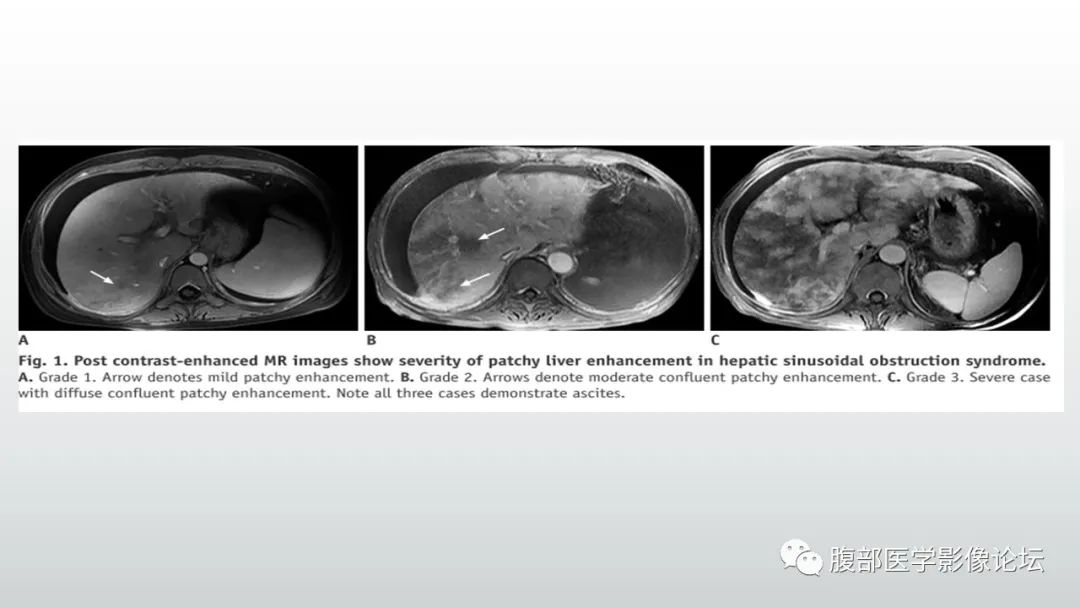 影像PPT - 【病例】肝窦阻塞综合征（肝小静脉闭塞病）CT及MR一例-25