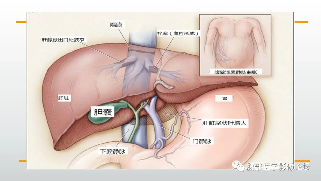 影像PPT - 【病例】肝窦阻塞综合征（肝小静脉闭塞病）CT及MR一例-29