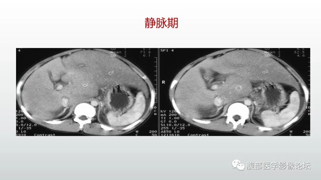 影像PPT - 【病例】肝窦阻塞综合征（肝小静脉闭塞病）CT及MR一例-35