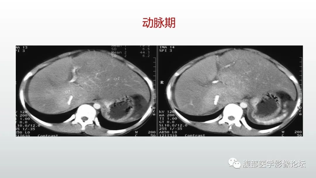 影像PPT - 【病例】肝窦阻塞综合征（肝小静脉闭塞病）CT及MR一例-34
