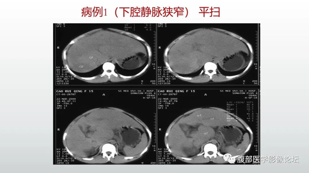 影像PPT - 【病例】肝窦阻塞综合征（肝小静脉闭塞病）CT及MR一例-33