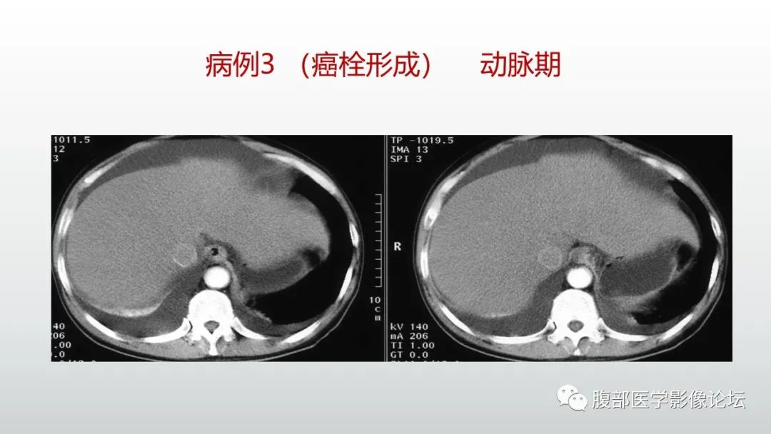 影像PPT - 【病例】肝窦阻塞综合征（肝小静脉闭塞病）CT及MR一例-37
