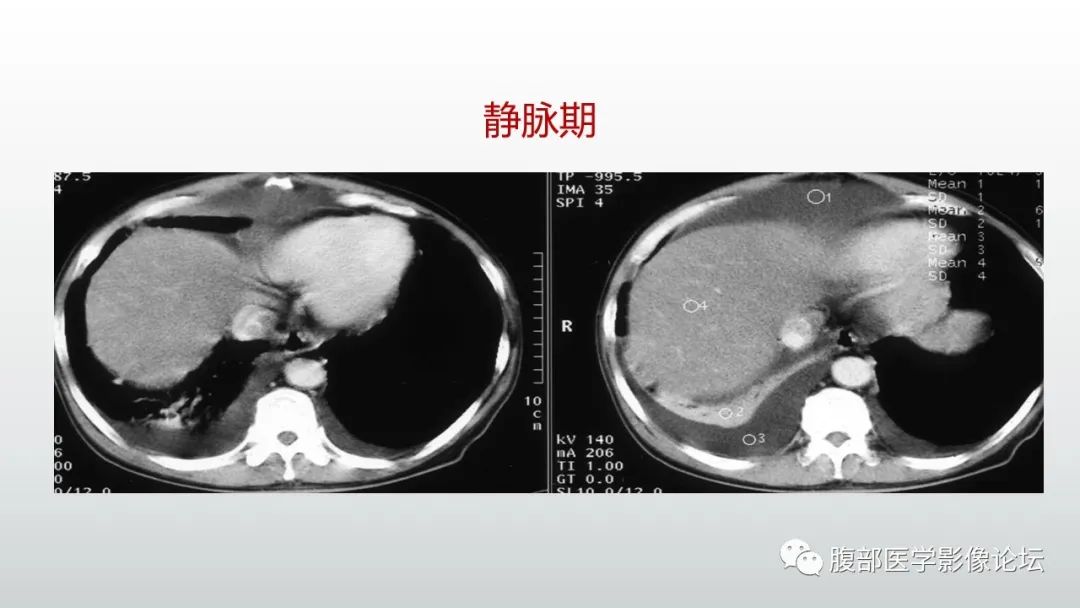 影像PPT - 【病例】肝窦阻塞综合征（肝小静脉闭塞病）CT及MR一例-38