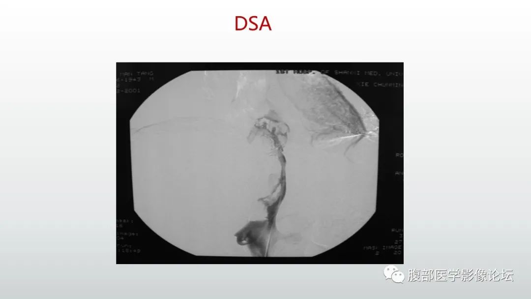 影像PPT - 【病例】肝窦阻塞综合征（肝小静脉闭塞病）CT及MR一例-39