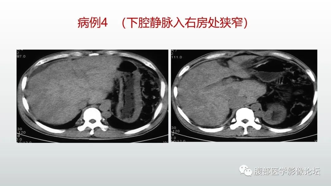 影像PPT - 【病例】肝窦阻塞综合征（肝小静脉闭塞病）CT及MR一例-40