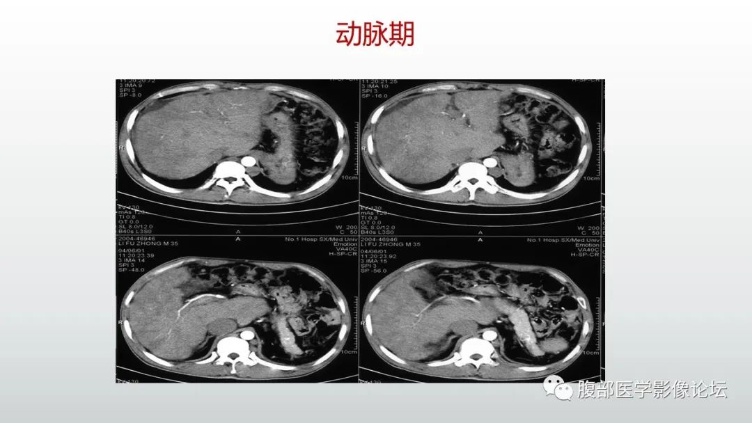 影像PPT - 【病例】肝窦阻塞综合征（肝小静脉闭塞病）CT及MR一例-41