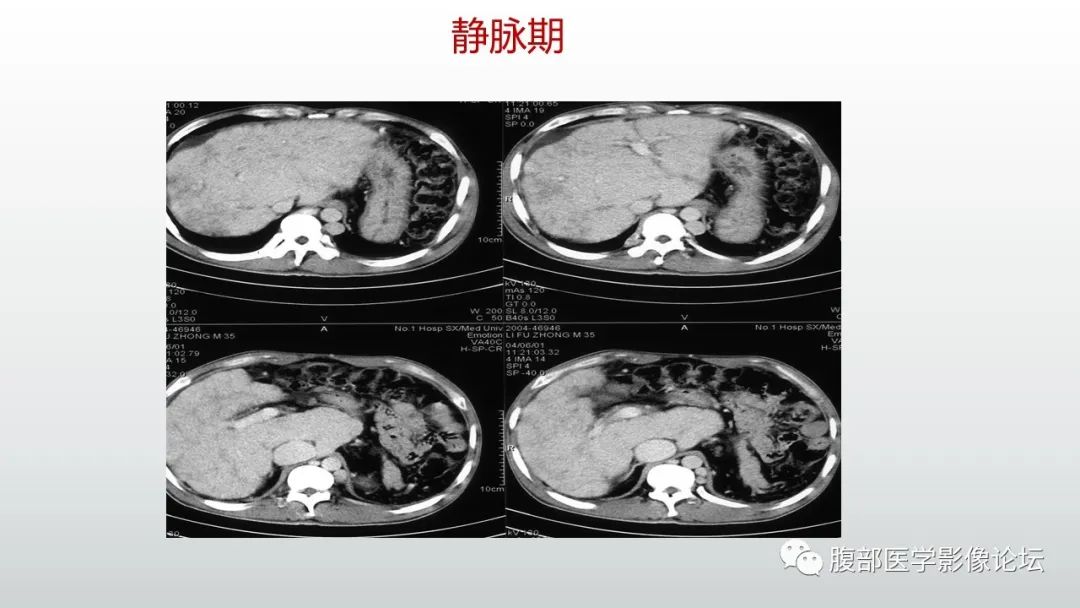 影像PPT - 【病例】肝窦阻塞综合征（肝小静脉闭塞病）CT及MR一例-42