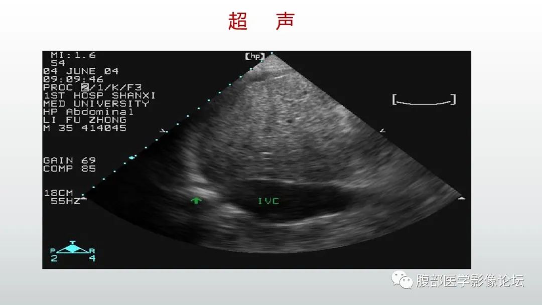 影像PPT - 【病例】肝窦阻塞综合征（肝小静脉闭塞病）CT及MR一例-43