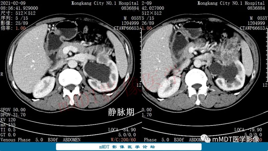 影像PPT - 【病例】肾透明细胞癌1例CT影像-7 影像PPT - 【病例】肾透明细胞癌1例CT影像-7