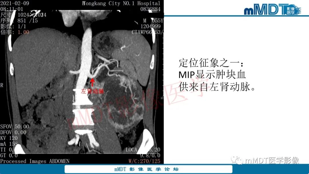 影像PPT - 【病例】肾透明细胞癌1例CT影像-12 影像PPT - 【病例】肾透明细胞癌1例CT影像-12