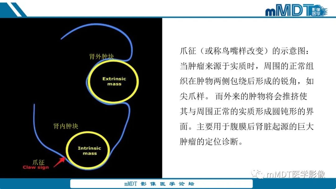 影像PPT - 【病例】肾透明细胞癌1例CT影像-14 影像PPT - 【病例】肾透明细胞癌1例CT影像-14