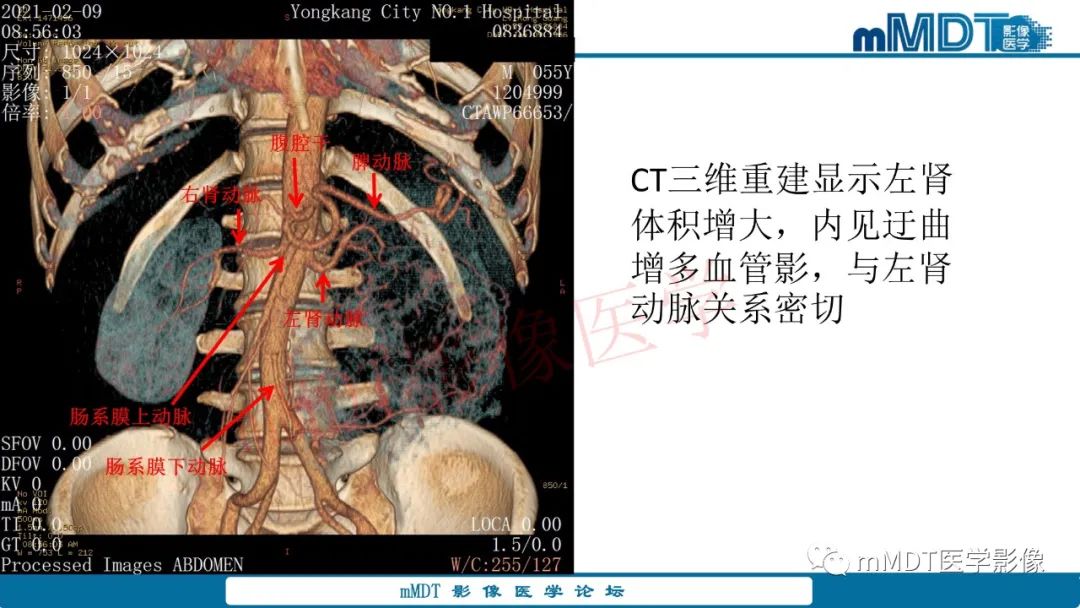 影像PPT - 【病例】肾透明细胞癌1例CT影像-11 影像PPT - 【病例】肾透明细胞癌1例CT影像-11