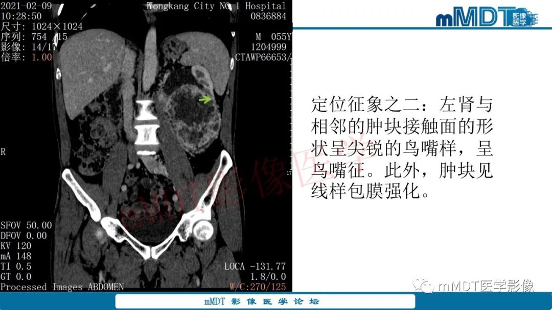 影像PPT - 【病例】肾透明细胞癌1例CT影像-13 影像PPT - 【病例】肾透明细胞癌1例CT影像-13