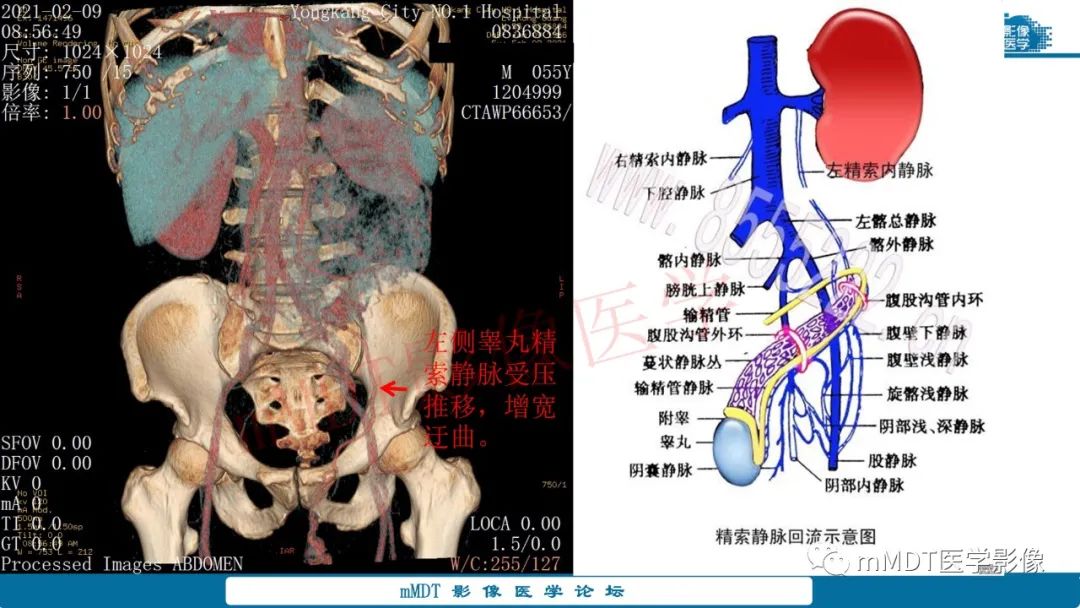 影像PPT - 【病例】肾透明细胞癌1例CT影像-20 影像PPT - 【病例】肾透明细胞癌1例CT影像-20