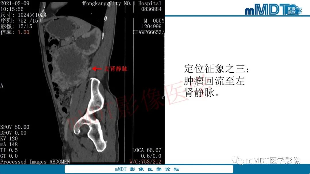 影像PPT - 【病例】肾透明细胞癌1例CT影像-18 影像PPT - 【病例】肾透明细胞癌1例CT影像-18