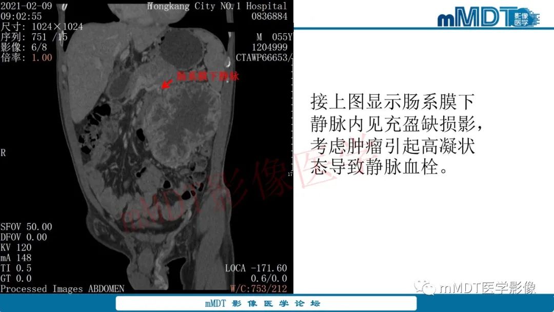 影像PPT - 【病例】肾透明细胞癌1例CT影像-22 影像PPT - 【病例】肾透明细胞癌1例CT影像-22