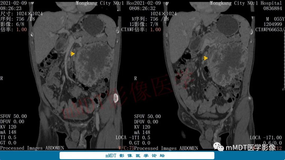 影像PPT - 【病例】肾透明细胞癌1例CT影像-26 影像PPT - 【病例】肾透明细胞癌1例CT影像-26
