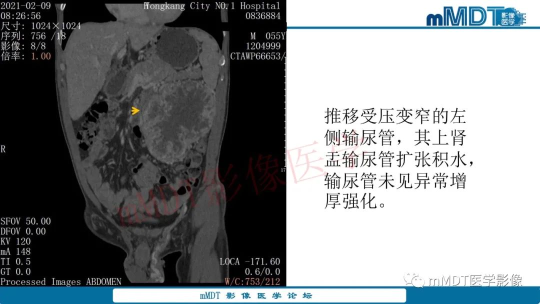 影像PPT - 【病例】肾透明细胞癌1例CT影像-27 影像PPT - 【病例】肾透明细胞癌1例CT影像-27